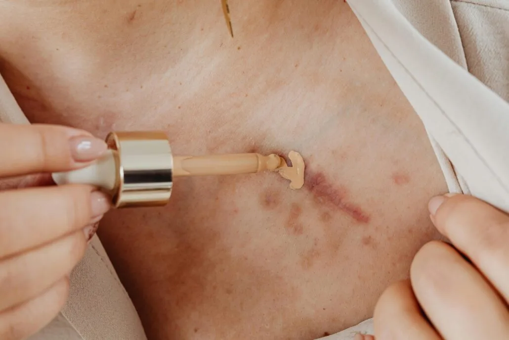 accident disfigurement concealment